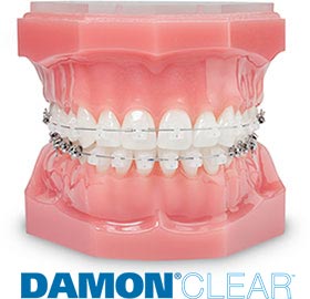 Damon Clear orthodontics